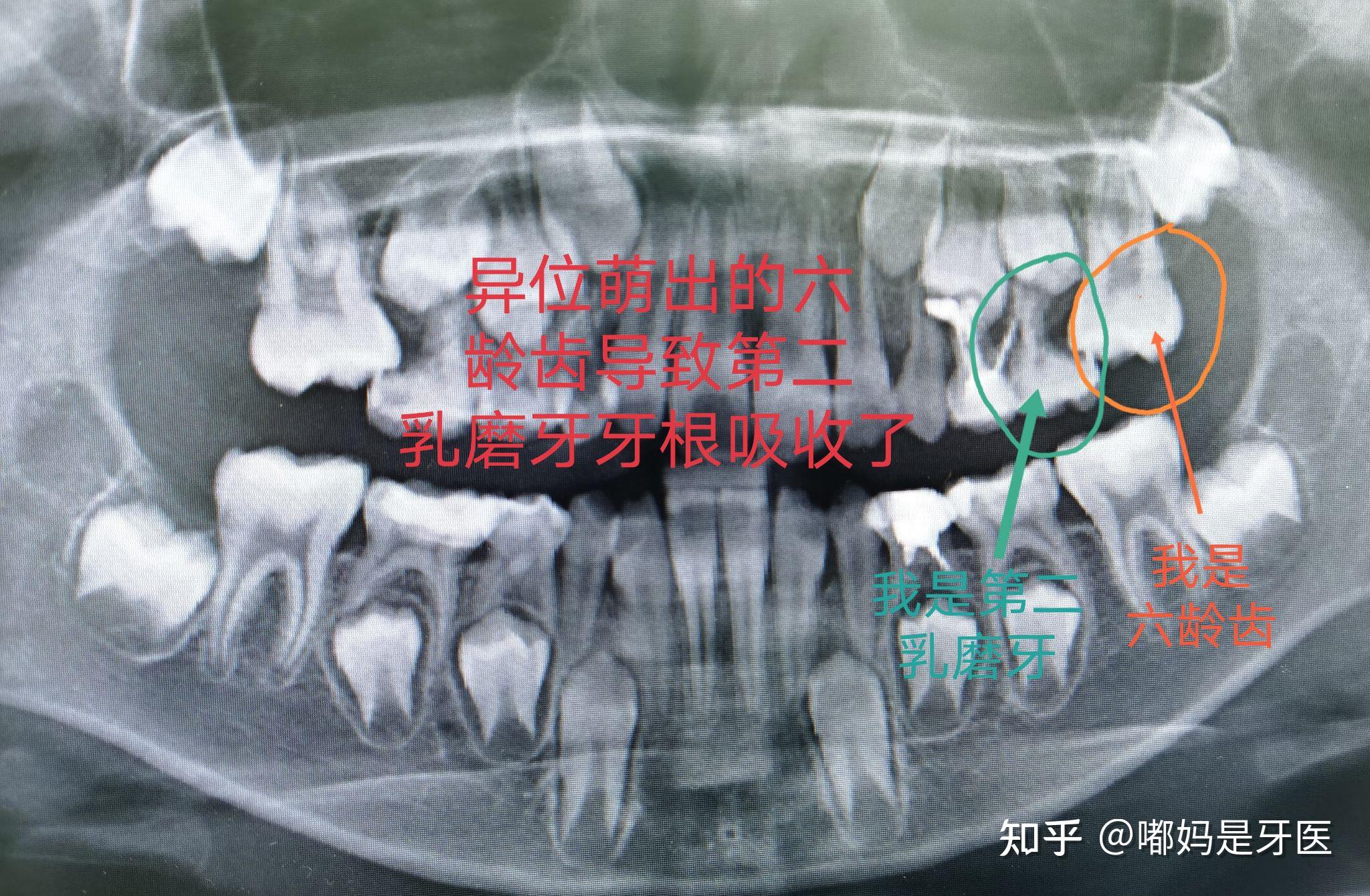 六龄齿异位萌出,导致前方的乳牙牙根吸收第一乳磨牙严重根尖炎,需要