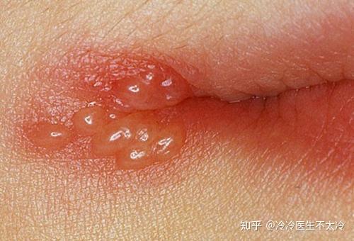 肛周疱疹是什么原因图片