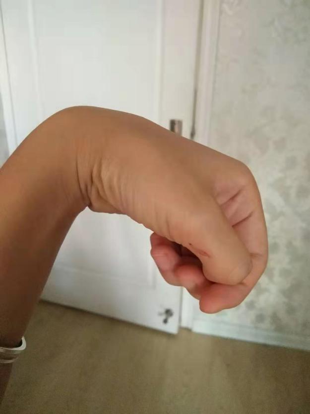 手指屈肌肌腱修补术后康复训练