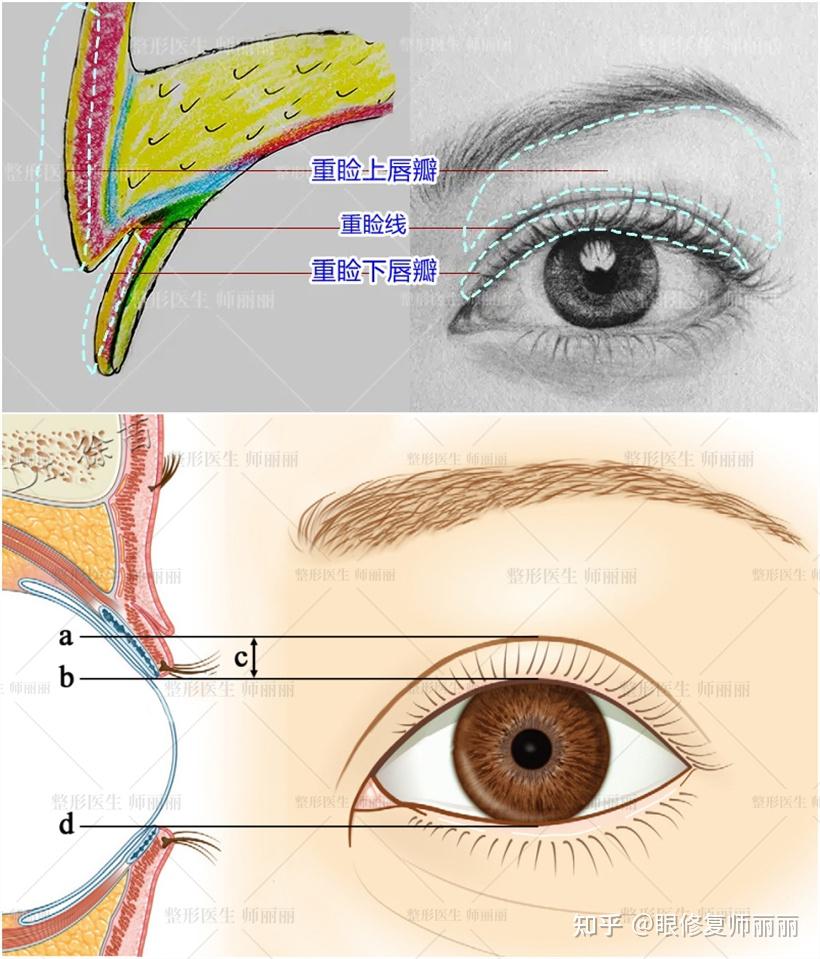 双眼皮宽改窄一定要保留疤痕吗