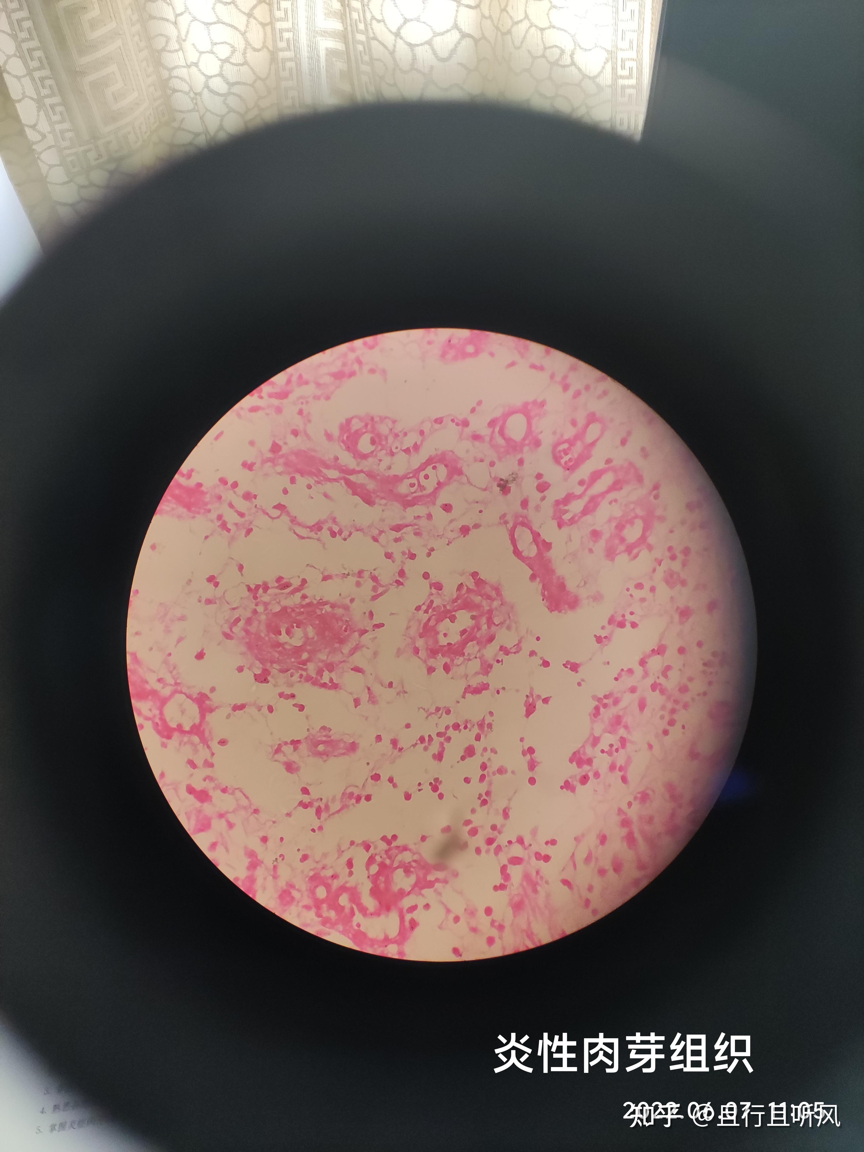 宫颈慢性炎性息肉10.异物肉芽肿