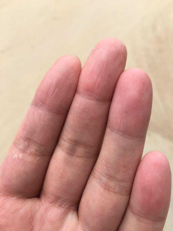 求问各位手蜕皮怎么办图片如下谢谢各位