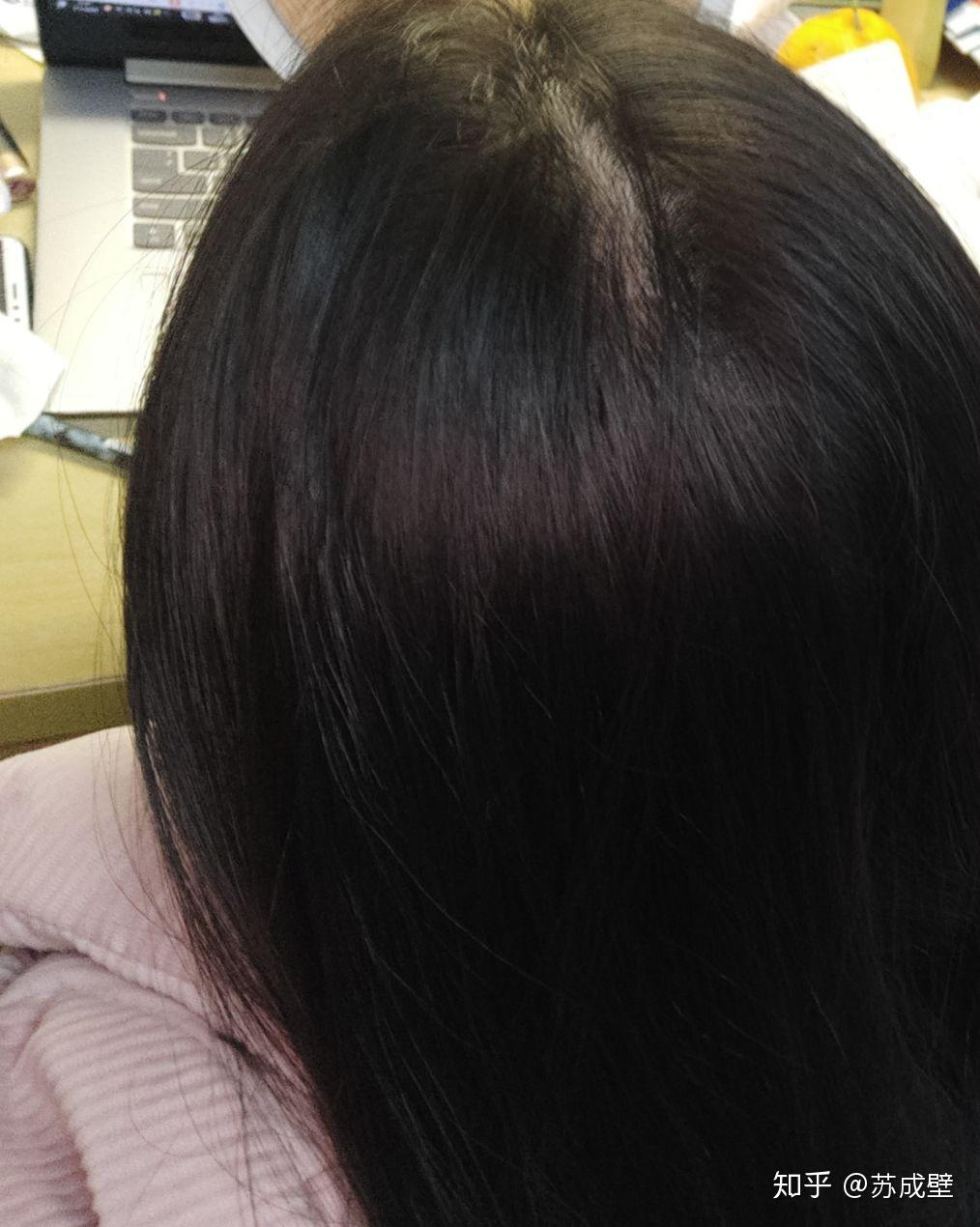 女生秃顶是怎样一种体验