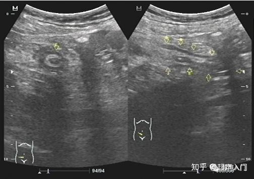 初学超声,如何快速找到阑尾?