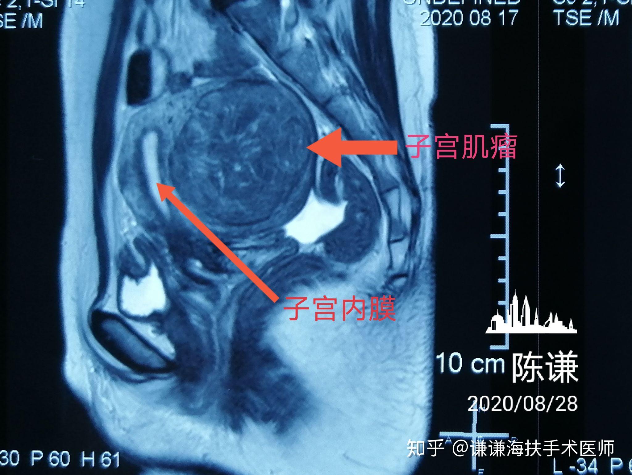 3,肌瘤縮小時間:由於每個病人體質差異,肌瘤吸收時間從幾個月到2年,大