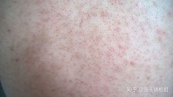 毛孔堵塞可以擦身体乳吗(脸上涂很多乳液会堵塞毛孔吗)