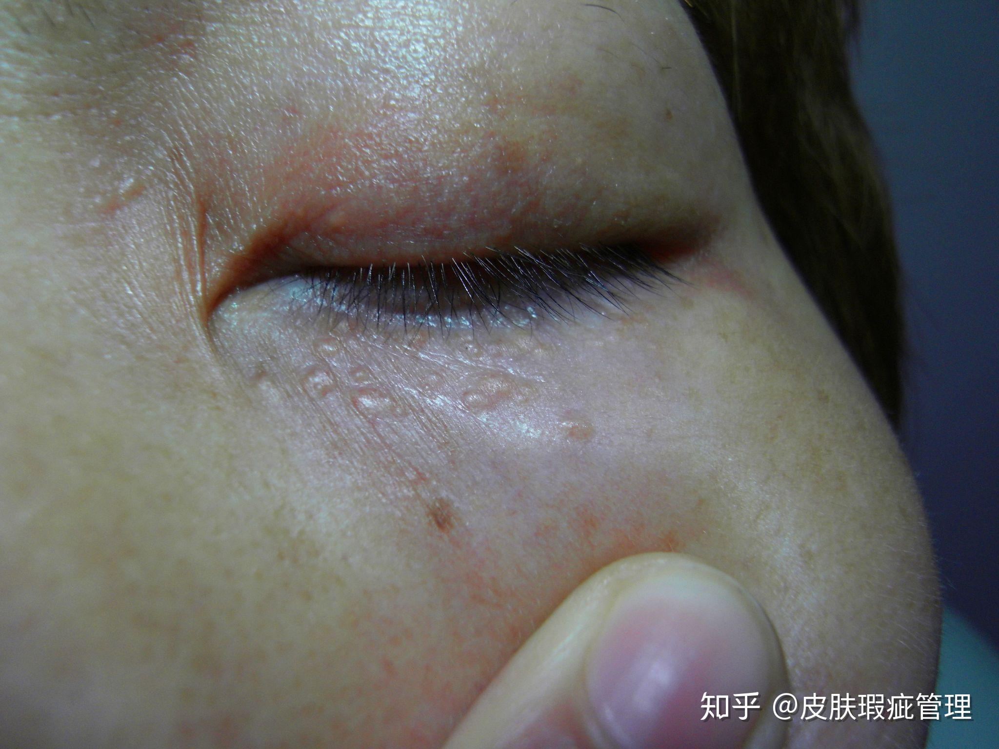 汗管瘤的发病原因是什么?