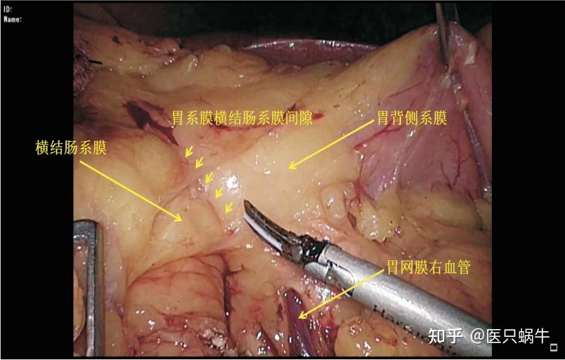 池畔专题结直肠解剖图谱及手术技巧分享01