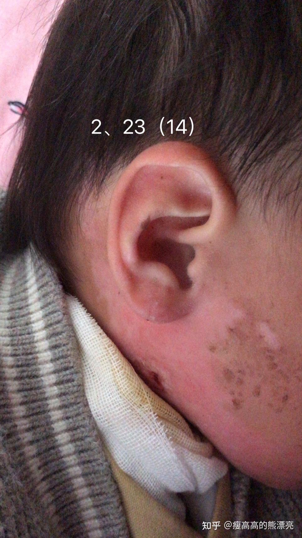 记录儿子烫伤抗疤路程烫伤疤痕增生疤痕修复