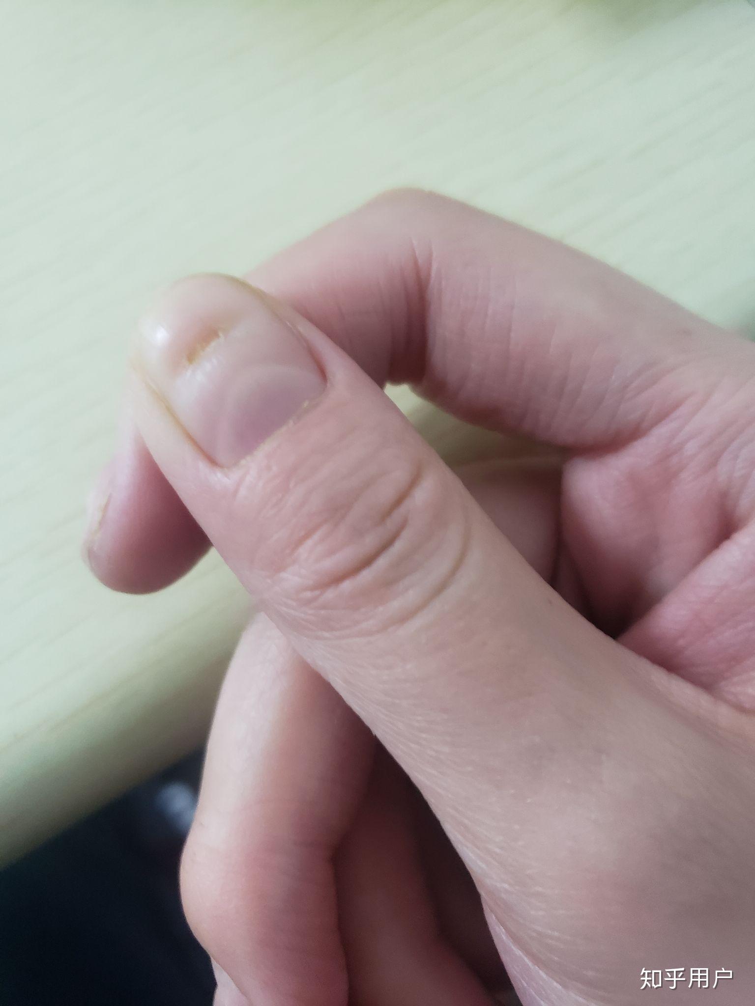 我的指甲印象中从小就坑坑洼洼大学后凹陷的更厉害还被家里当成灰指甲