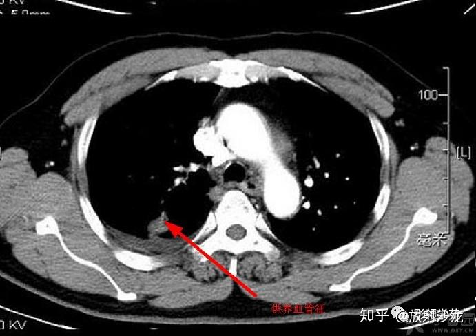 暈輪徵提示肺結節或腫塊出血,ct表現為結節或腫塊周圍磨玻璃密度影