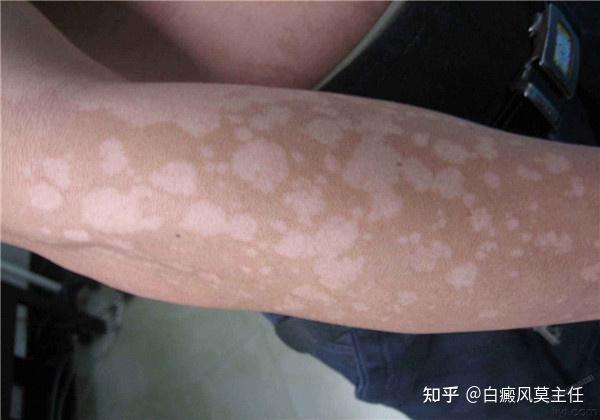 在临床上,常通过伍德灯检查,来确诊两种皮肤病.