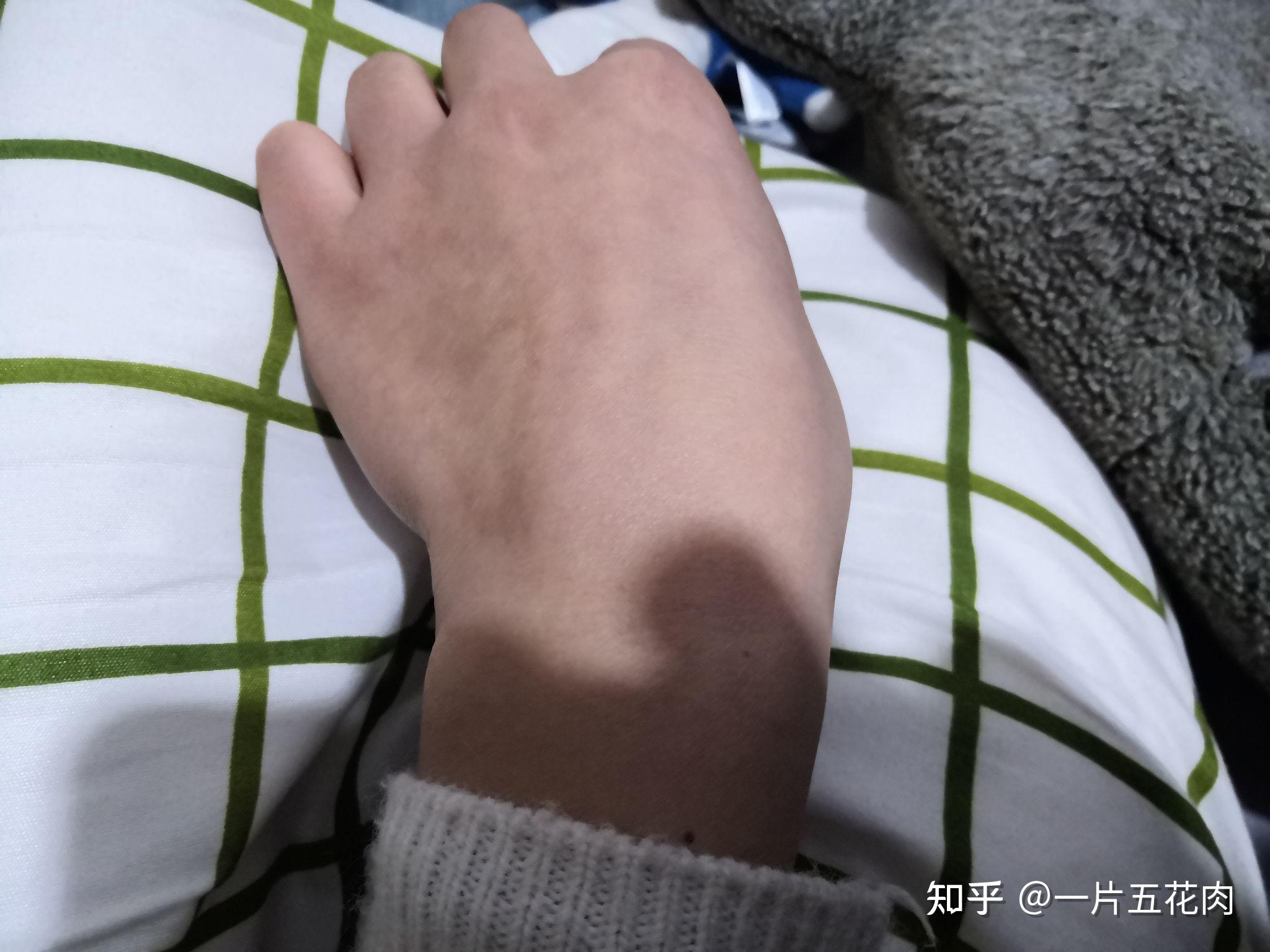 右手手背有很大疤痕很自卑找工作特别难怎么办