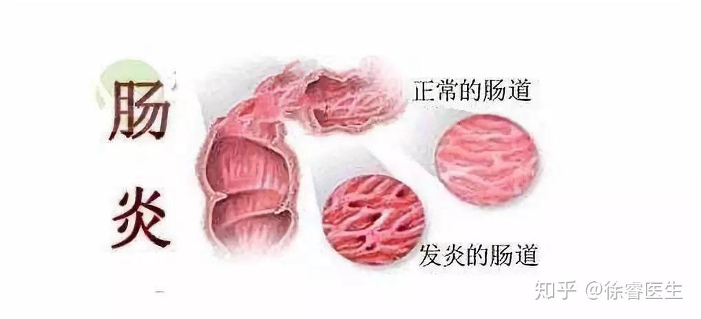 国庆假期后医院肠炎患者增多,为何秋季急性肠炎更高发? - 知乎