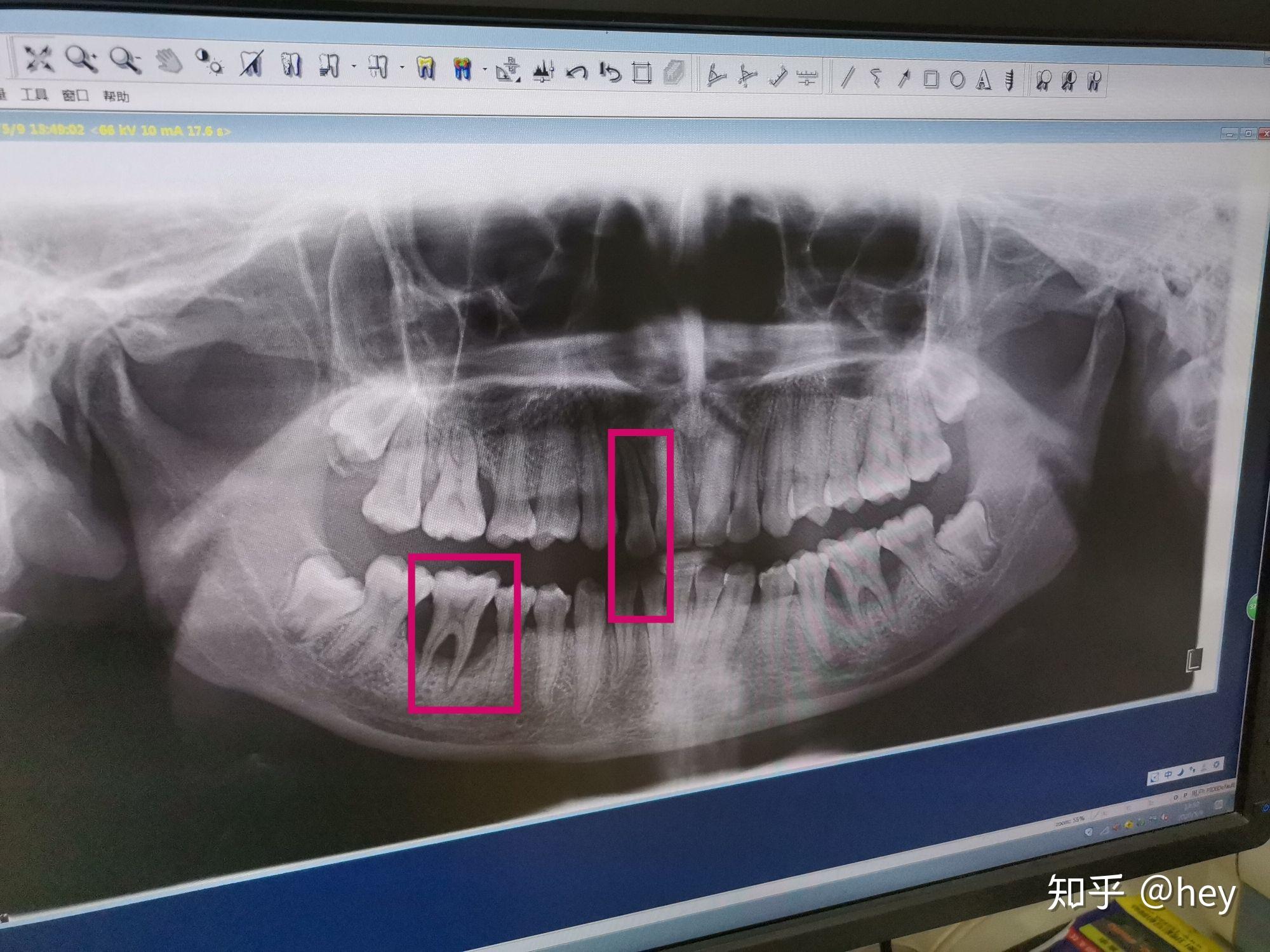 牙周炎拍片解析图图片
