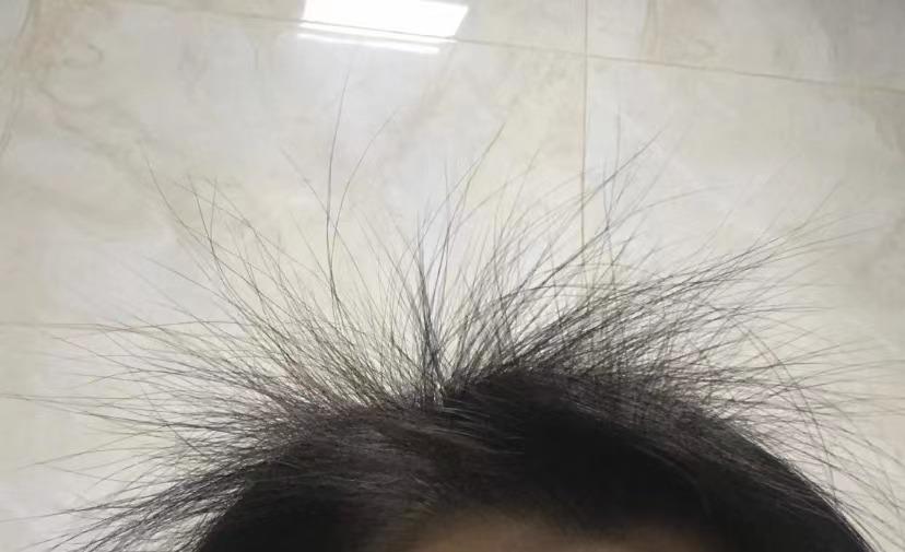 女生头发少怎样增加发量让头发变多?