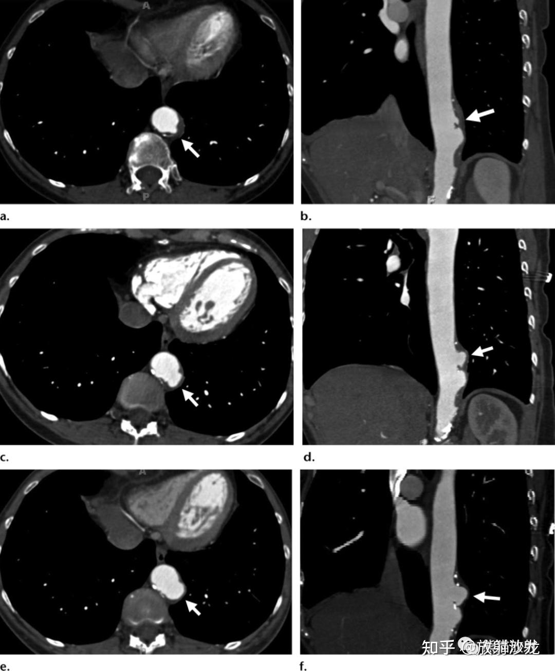 腹主动脉瘤的随访哪些ct征象提示其不稳定性