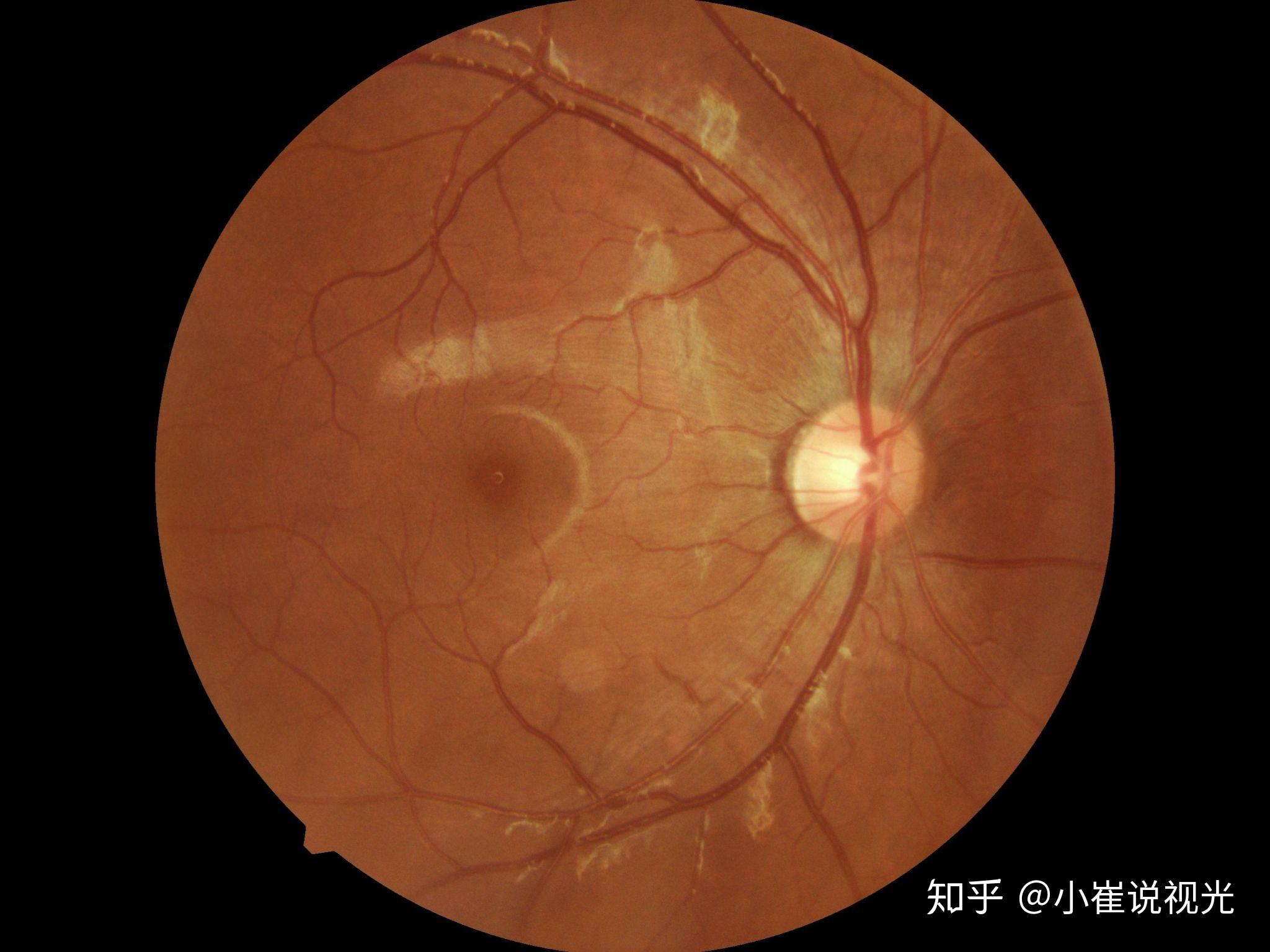 高度近视视网膜脱落的案例多吗什么样的剧烈运动不能做