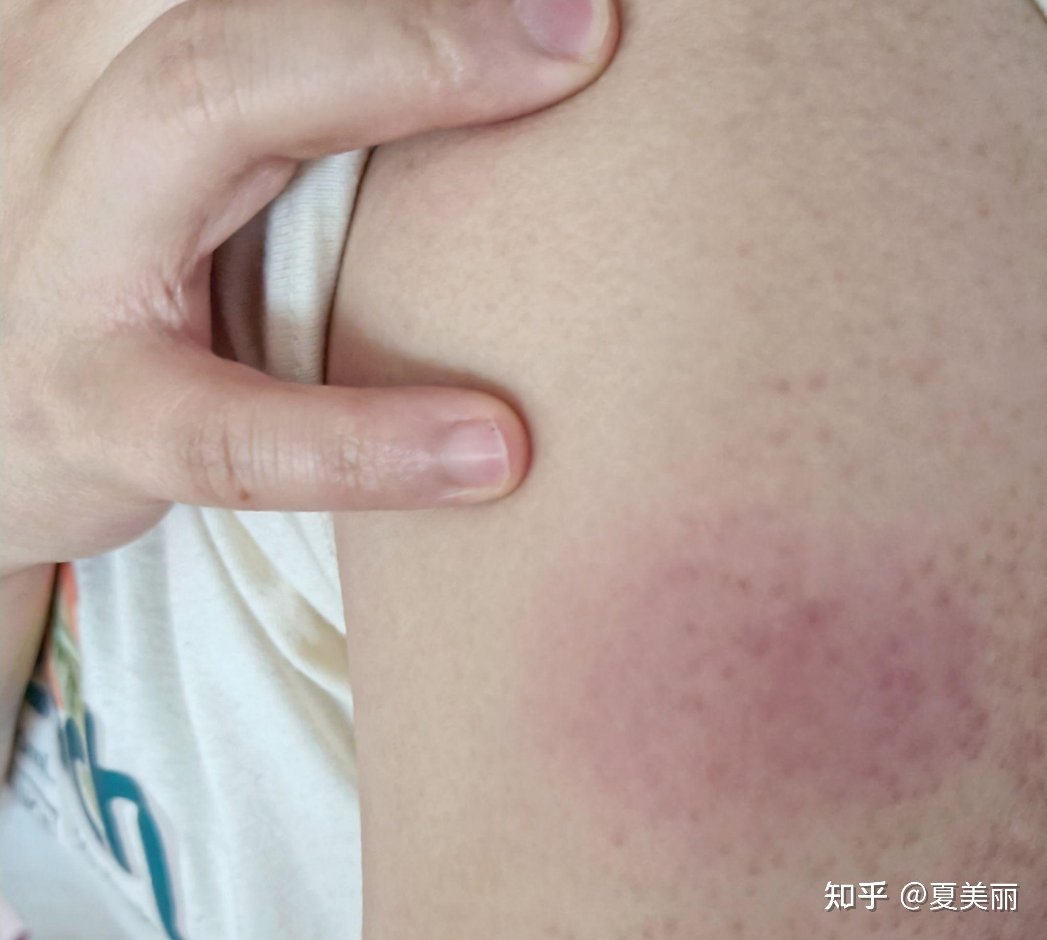 第三针新冠疫苗打完后,打针的地方红肿,痒,3天都没好(前两针都没任何