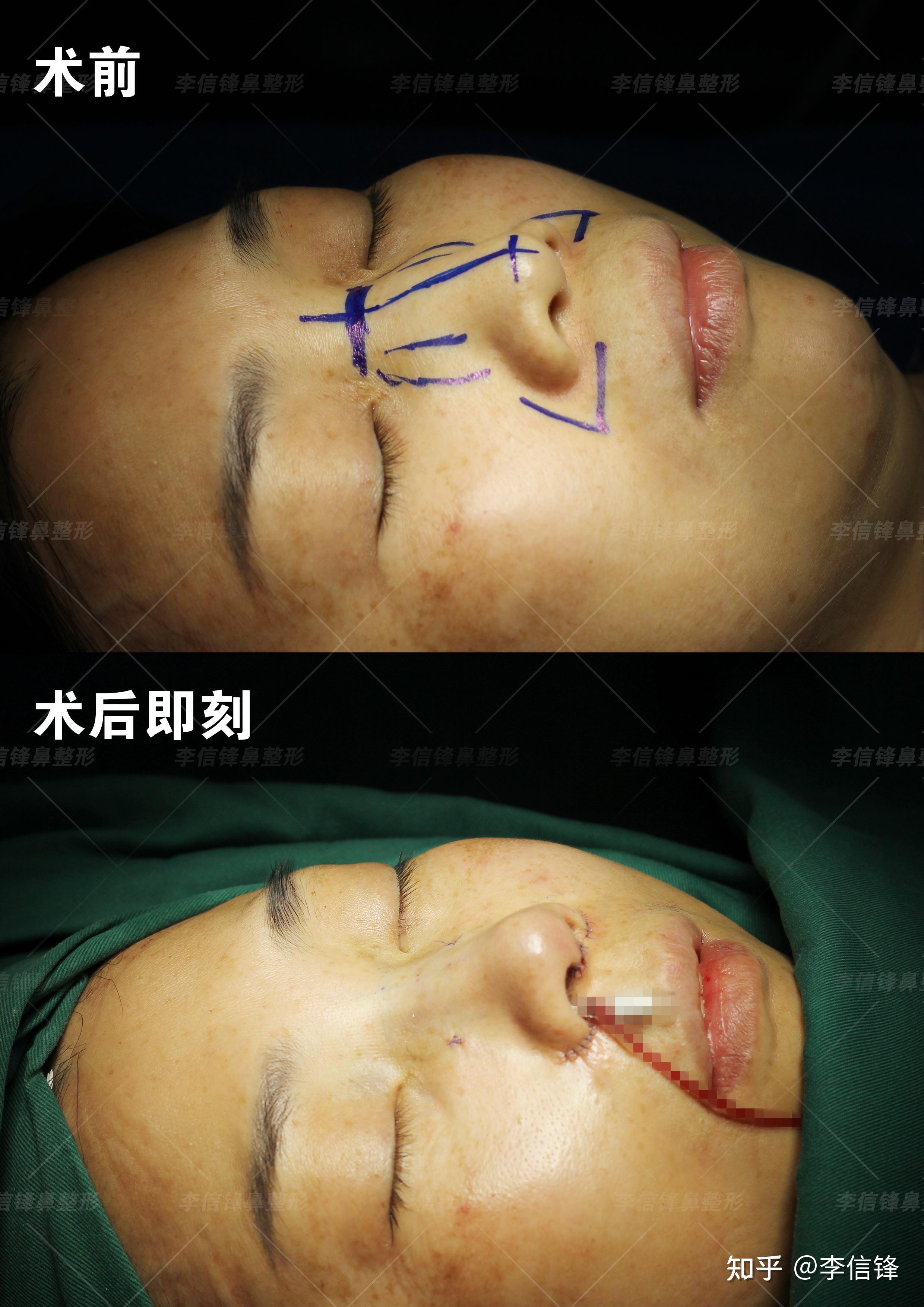 初鼻-宽鼻,面中部凹陷案例—术后即刻对比,鼻骨内推的变化也太大了吧!