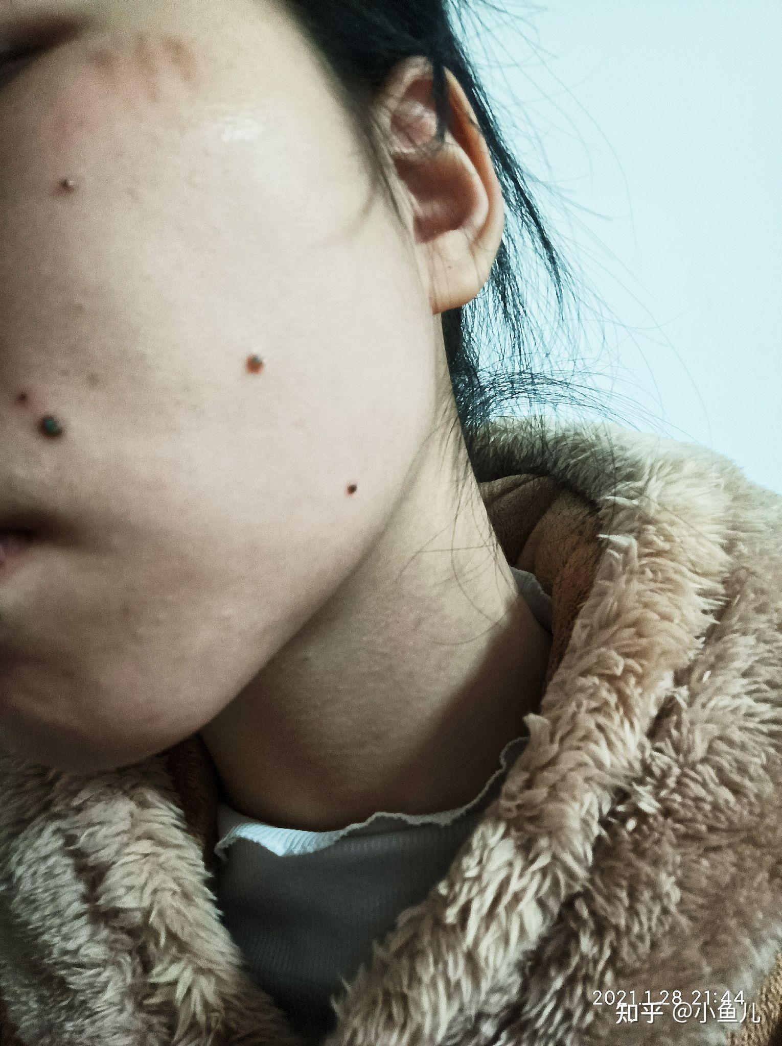 疼,再然后刺痛 火辣辣的疼,旁边还泛红药水去痣第一天,平痣都供起来了