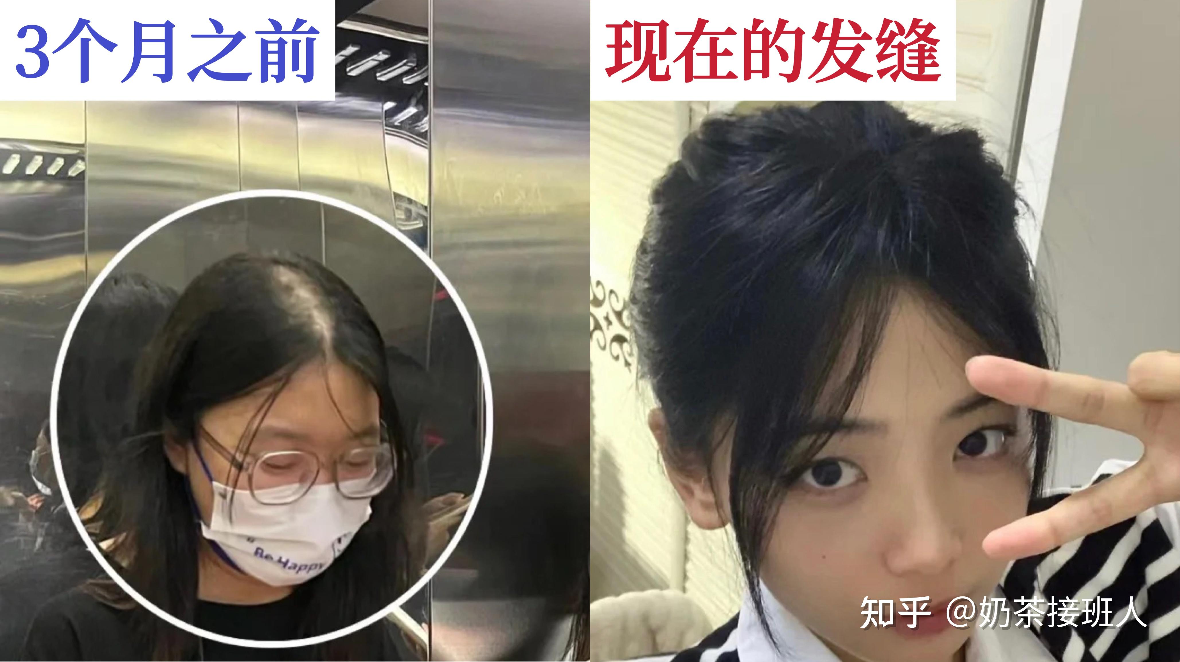 女生头发少怎样增加发量让头发变多?