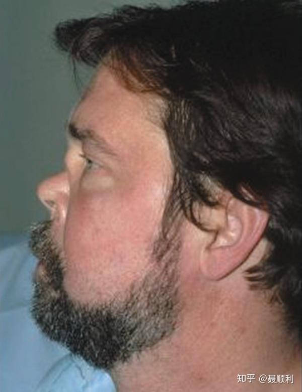 篇开始具体讨论肉芽肿性多血管炎(granulomatosis with polyangiitis