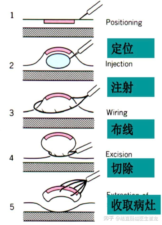 什么是内镜下黏膜切除术