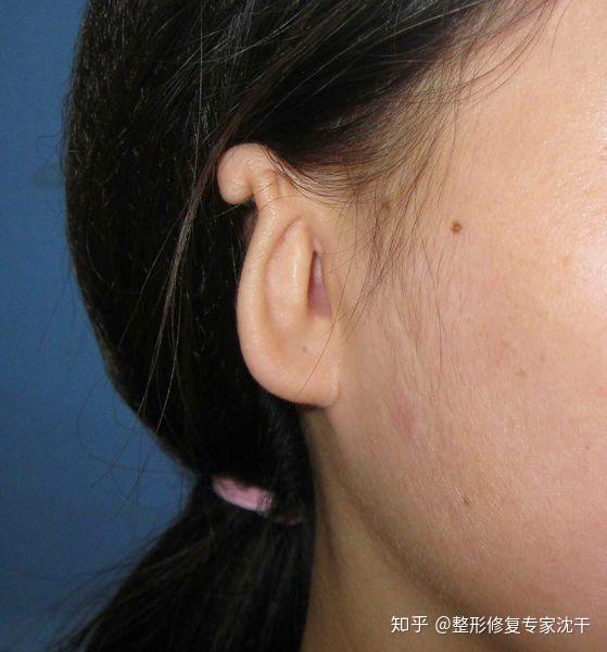 什么是扩张法小耳再造?how to reconstruct a ear by expander?