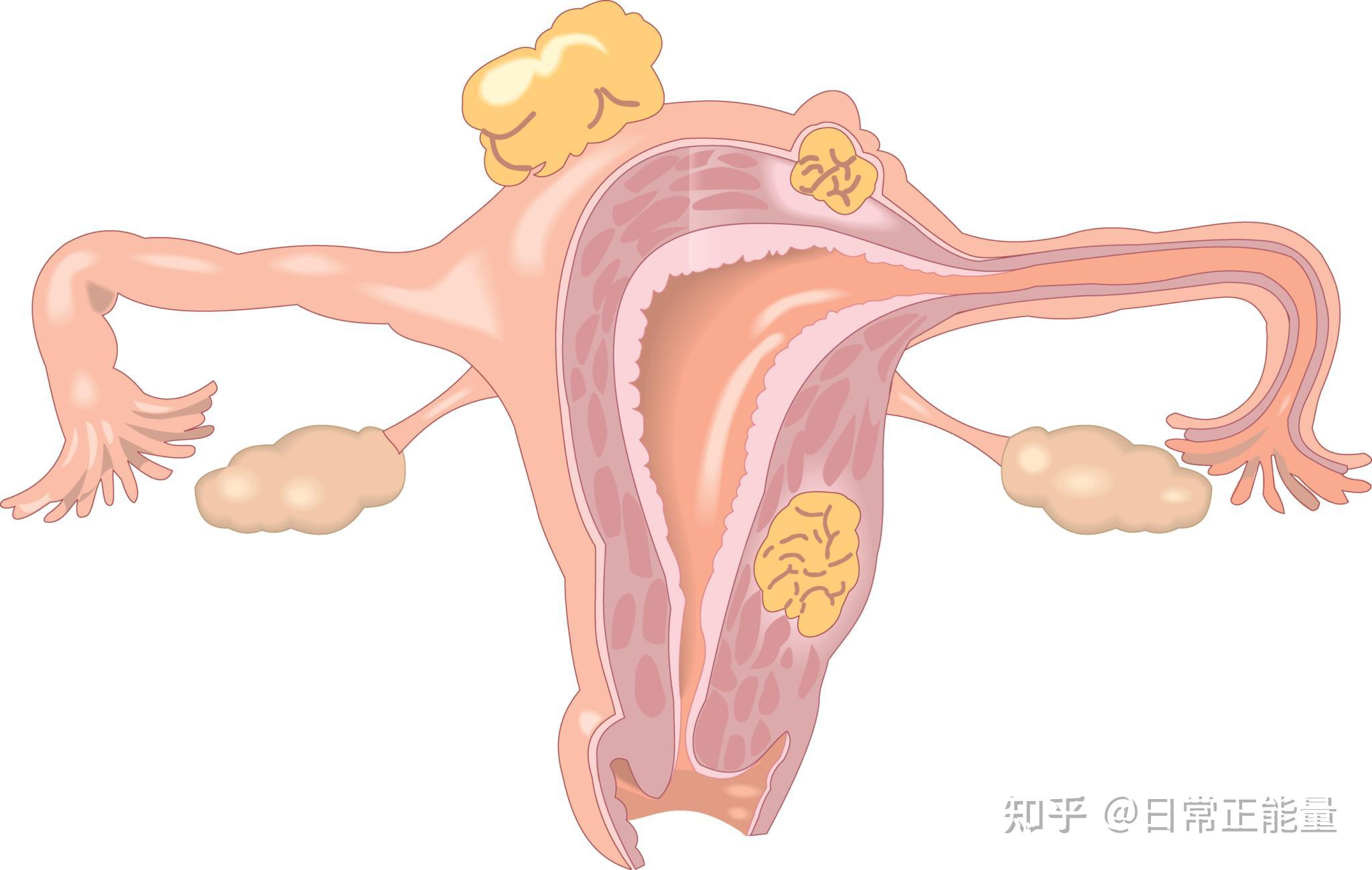 宫颈癌的宫颈图图片