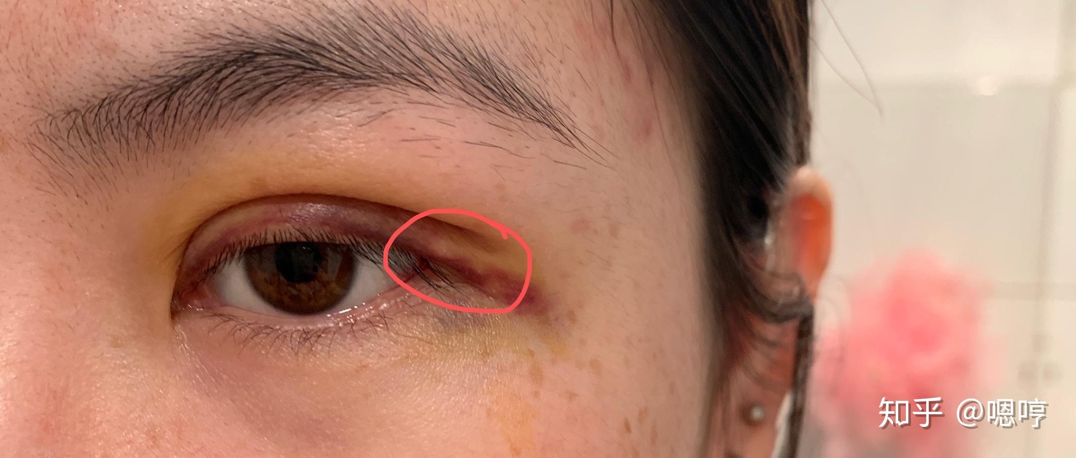 眼睛周围长汗管瘤是什么原因造成的？ - 知乎
