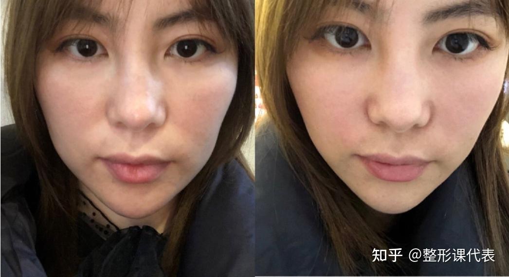少女针VS童颜针全方位详解：哪个抗衰效果好？能维持多久？多少钱一针？抗衰必看（建议收藏）！！ - 知乎
