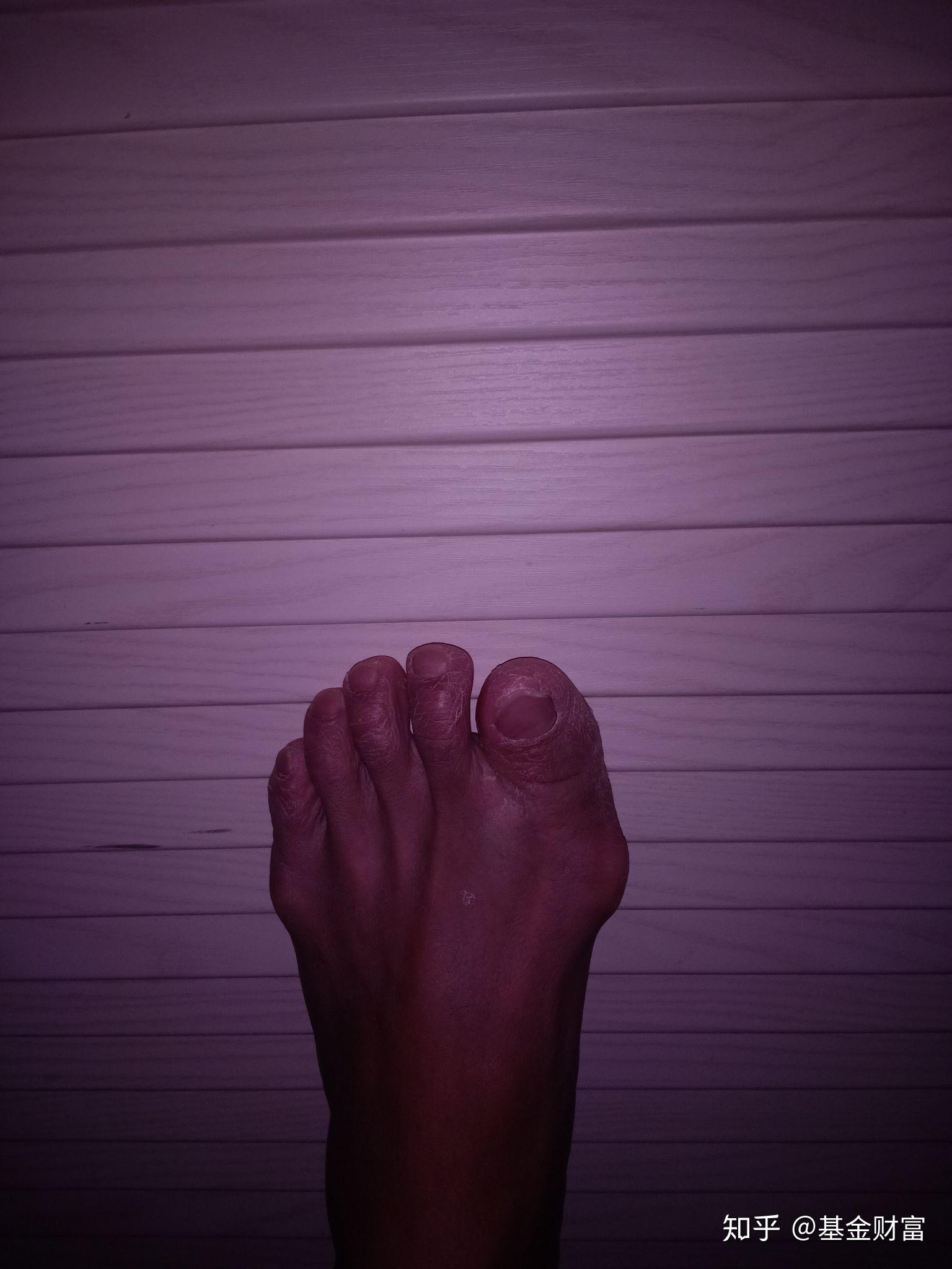 脚趾母弯了能当兵吗