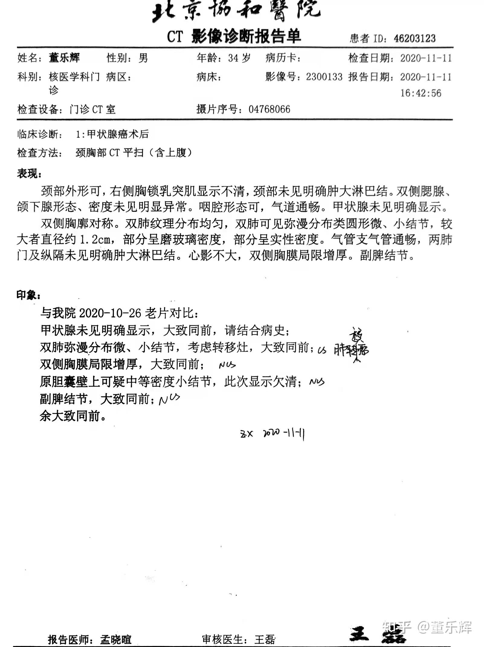 低分化甲状腺癌分化差的甲状腺癌肺转病例分享更新中