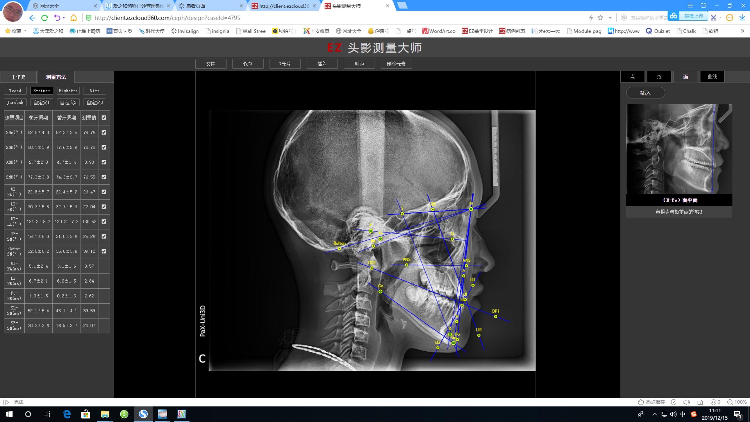 骨性下颌后缩,凸面型spark精靓隐形矫正设计思路
