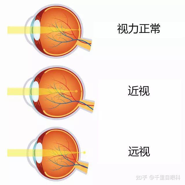 千里目眼科科普孩子的远视储备不足还有多久就会近视
