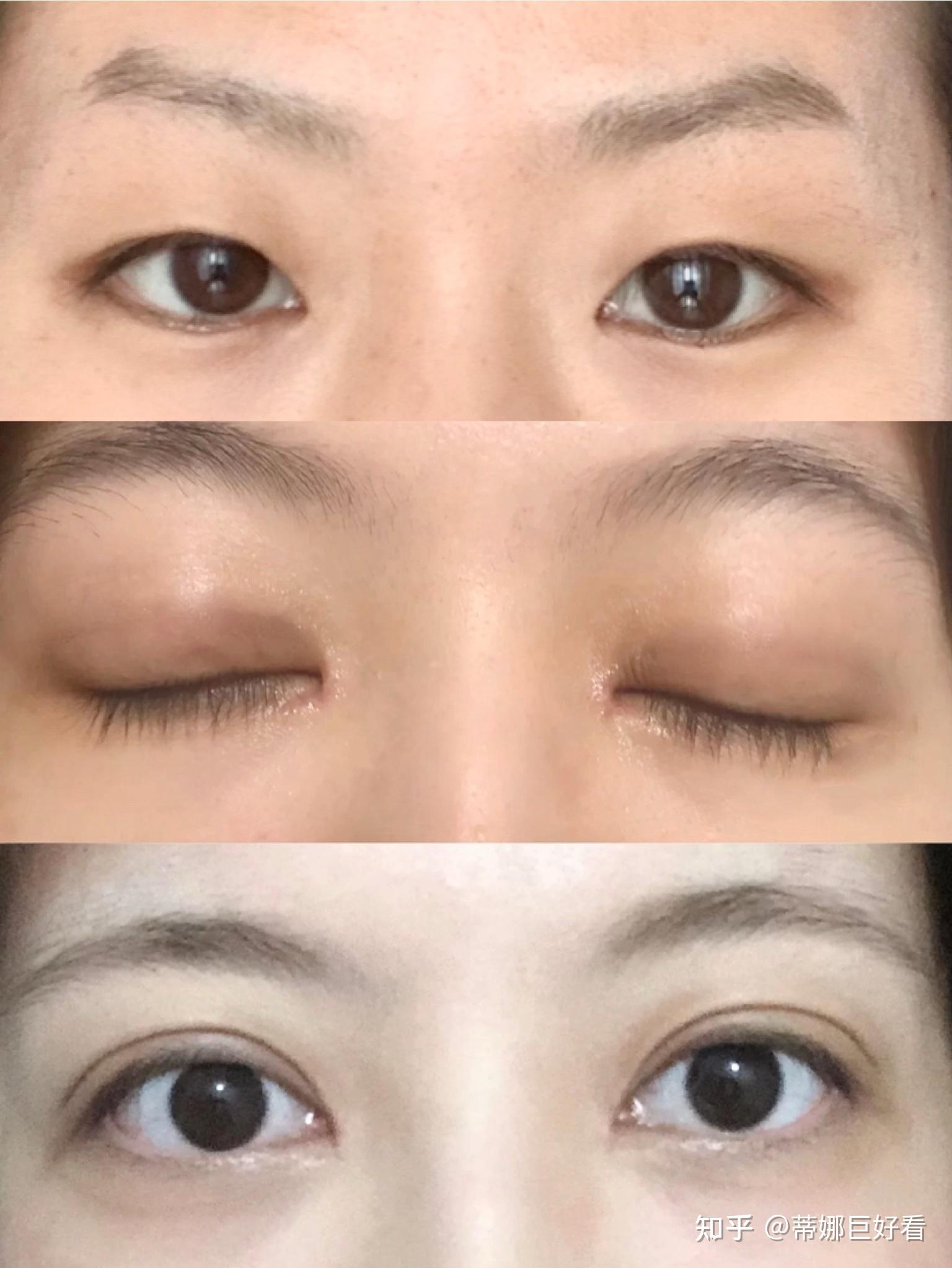 成都双眼皮哪个医生做的好想要自然妈生眼