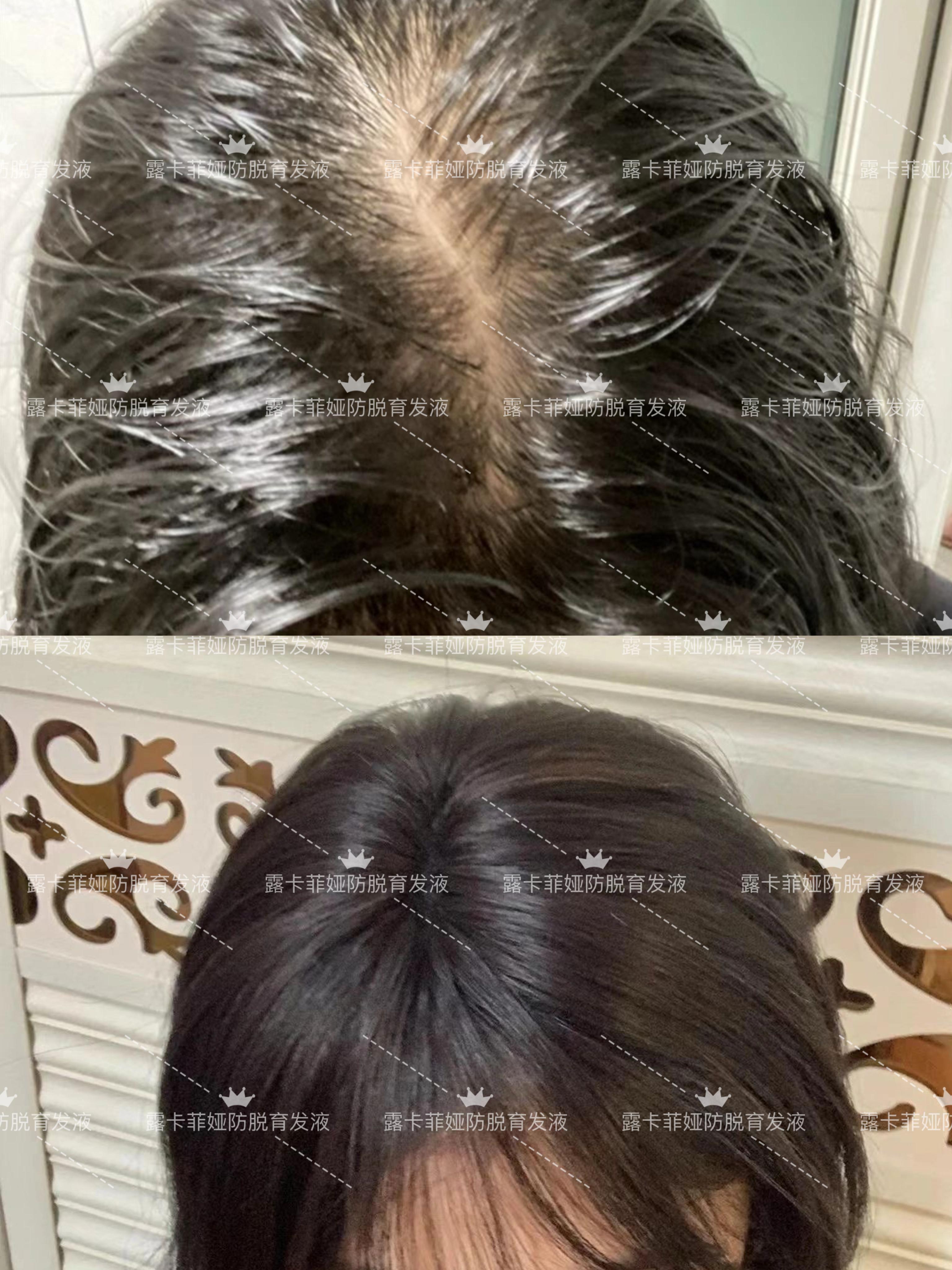 发缝稀疏怎么改善?这款育发液让你的发缝去无踪! - 知乎
