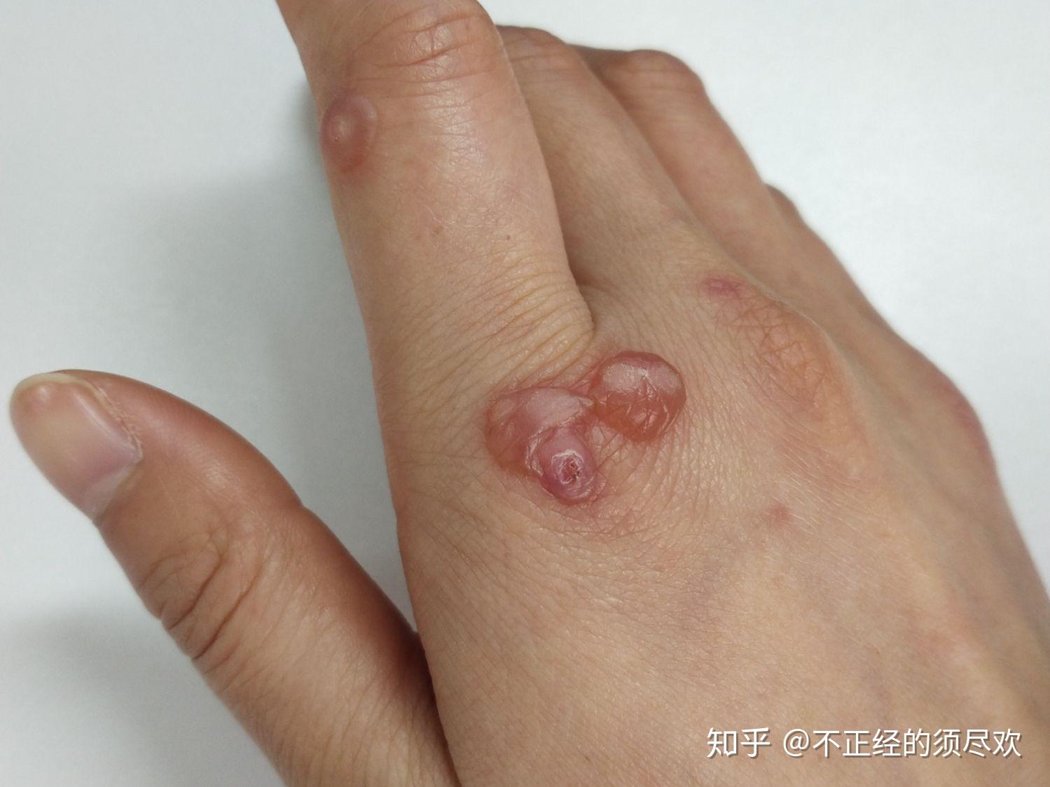 扁平疣冷冻治疗 - 知乎