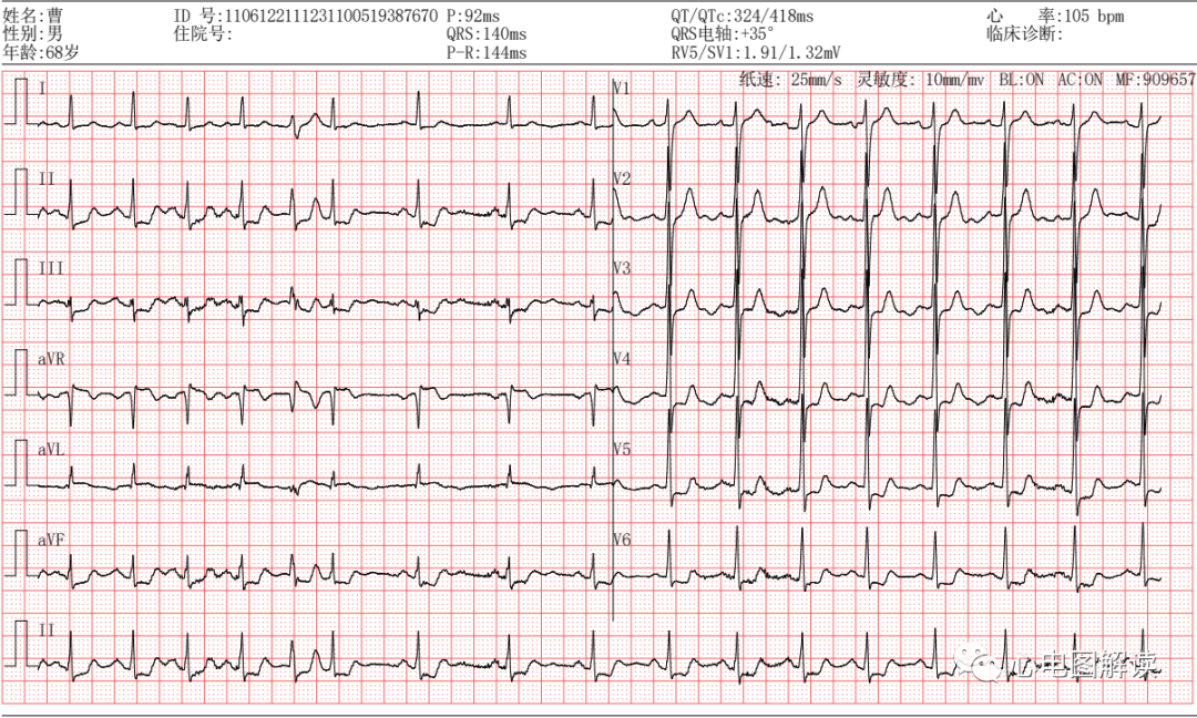 2t波改变1窦性心律,心电图诊断:t波:v1倒置,v2