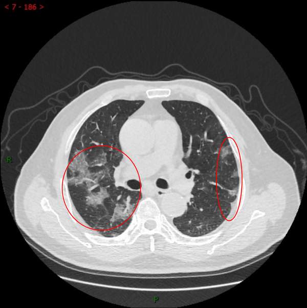 都在说"白肺"(带您看看白肺到底什么样?) - 浦东人才网