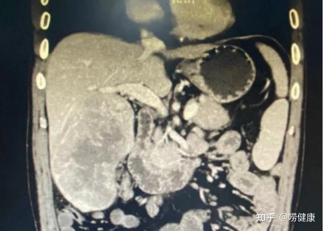 确诊胰头癌,依靠这个方法成功缩小肿瘤,实现手术切除 - 知乎