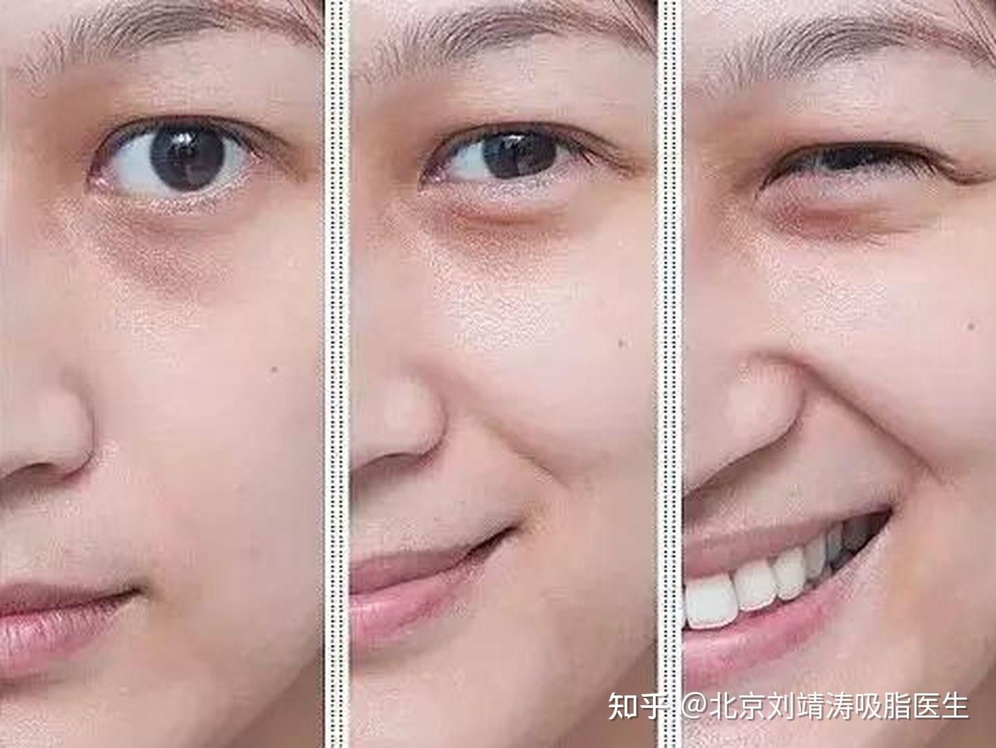 北京刘靖涛教你如何改善法令纹？ - 知乎