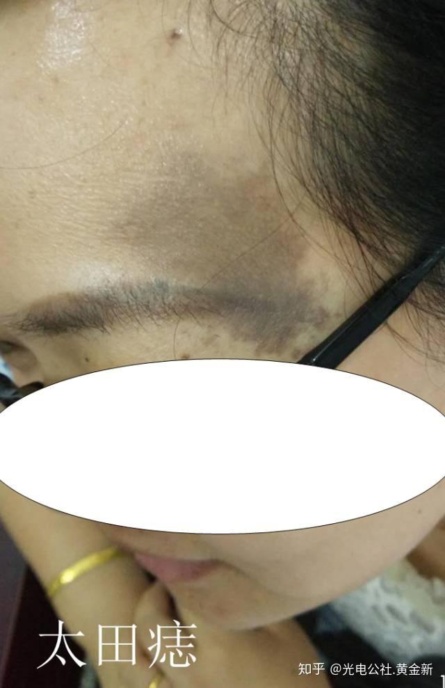 到底什么是胎记