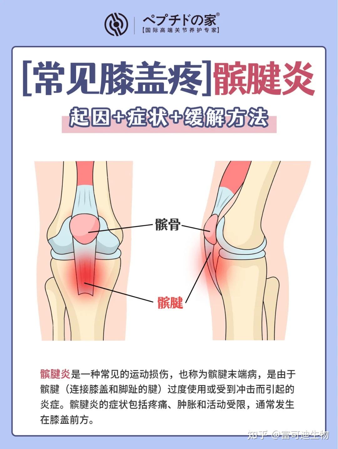 髌骨疼痛是什么原因图片