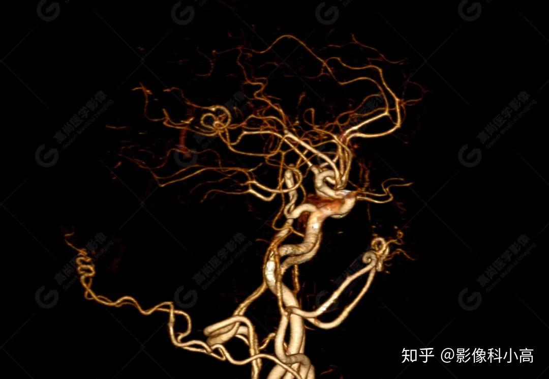 少见血管变异永存三叉动脉3例