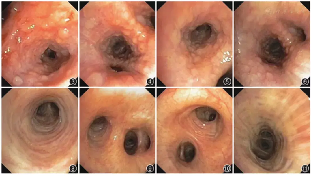 从左到右,分别是右中叶,右下叶,左上叶,左下叶支气管,黏膜多发肉芽肿