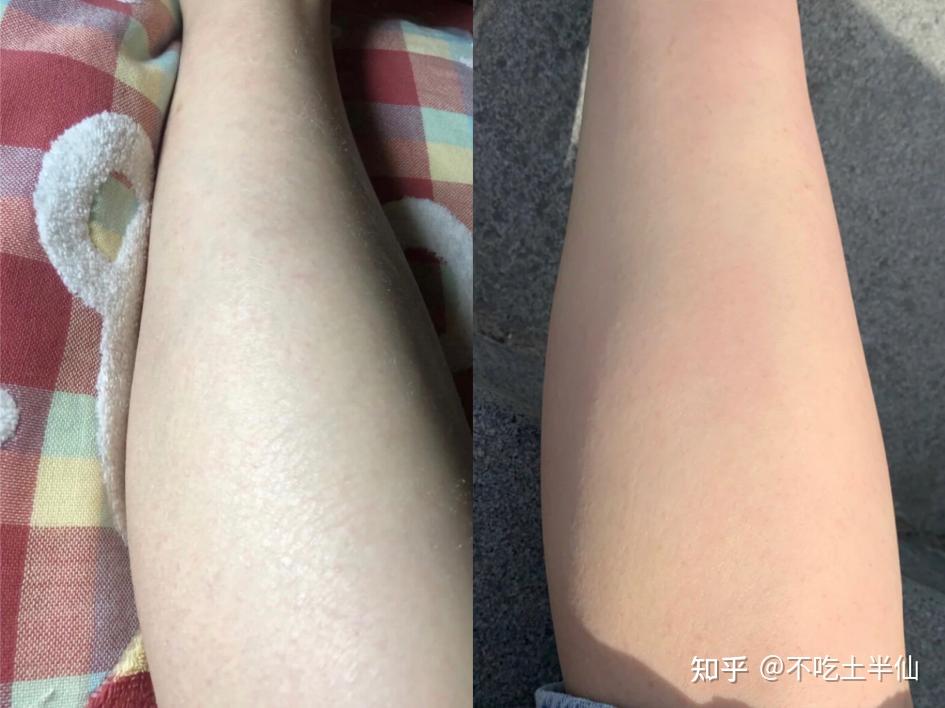 刮腿毛刮成鸡皮肤(总是刮腿毛大腿好像鸡皮肤)