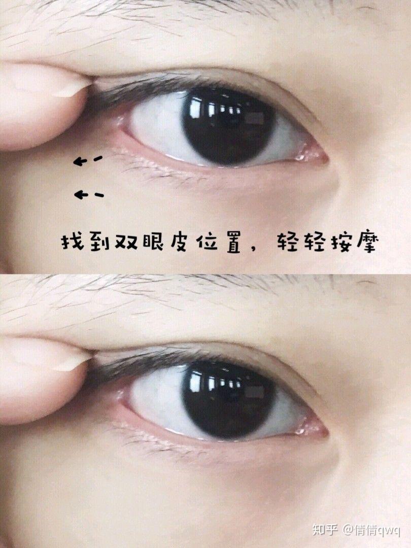 消除肿泡眼74还我大双眼皮按摩法92纯干货
