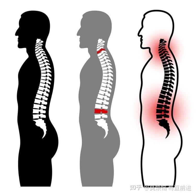 腰椎间盘突出就像出轨中医3种方法帮它走上正轨很实用